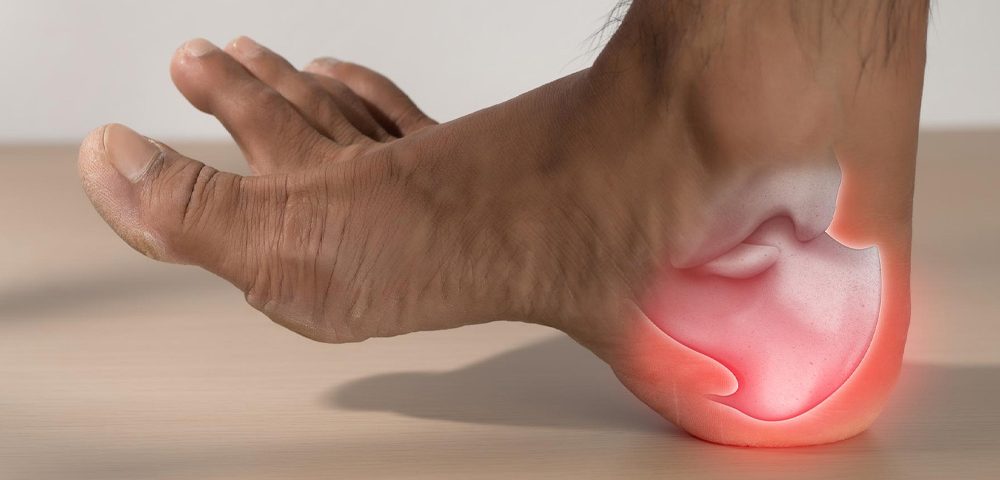 Plantar Fasciitis